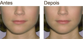 tratamento-correcao-assimetria-facial